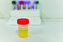 A jar containing a urine sample